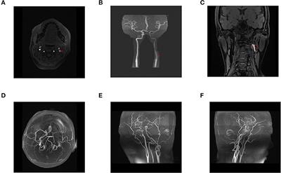 Case report: Traumatic carotid artery dissection after 7D High-Intensity Macro- and Micro-Focused Ultrasound treatment for skin laxity of the neck